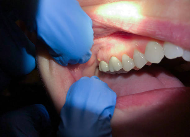 Best Lost Filling or Crown Replacement in West Lafayette, IN